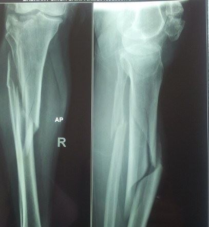 FRACTURE: Minimally invasive technique of fixation of comminuted long