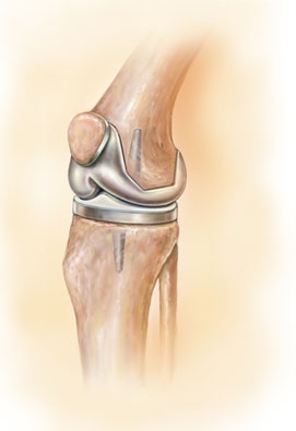 Total KNEE REPLACEMENT Chandigarh